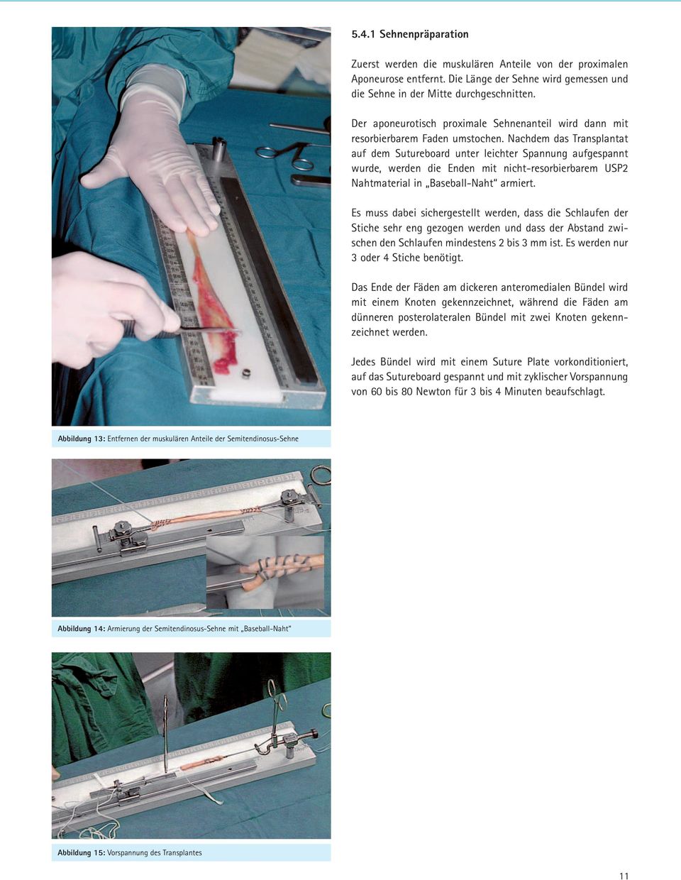 Nachdem das Transplantat auf dem Sutureboard unter leichter Spannung aufgespannt wurde, werden die Enden mit nicht-resorbierbarem USP2 Nahtmaterial in Baseball-Naht armiert.