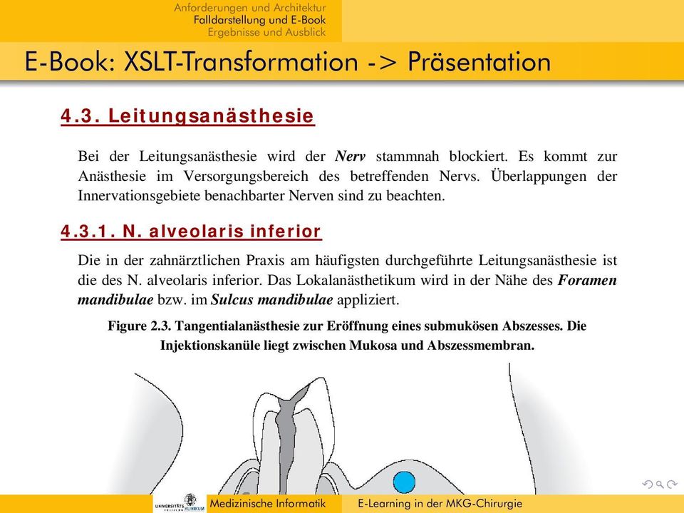 Es kommt zur Anästhesie im Versorgungsbereich des betreffenden Nervs. Überlappungen der Innervationsgebiete benachbarter Nerven sind zu beachten. 4.3.1. N. alveolaris inferior Die in der zahnärztlichen Praxis am häufigsten durchgeführte Leitungsanästhesie ist die des N.