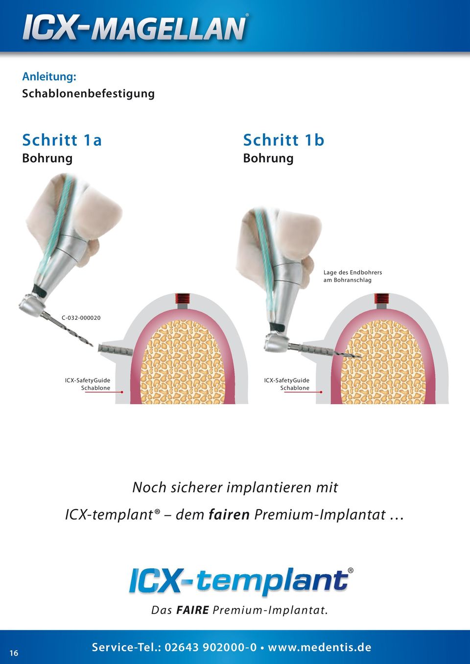 Schablone ICX-SafetyGuide Schablone Noch sicherer implantieren mit