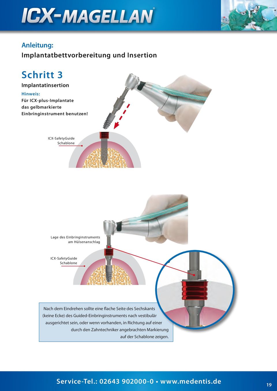 ICX-SafetyGuide Schablone Lage des Einbringinstruments am Hülsenanschlag ICX-SafetyGuide Schablone Nach dem Eindrehen sollte eine