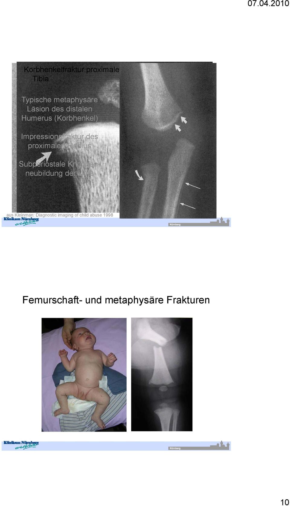 Knochen- neubildung der Ulna aus Kleinman: Diagnostic imaging of child