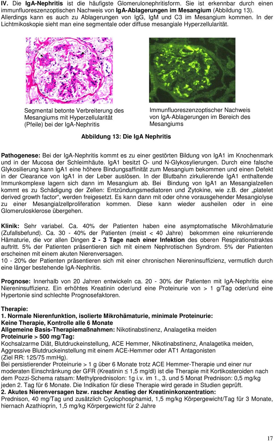 Segmental betonte Verbreiterung des Mesangiums mit Hyperzellularität (Pfeile) bei der IgA-Nephritis Immunfluoreszenzoptischer Nachweis von IgA-Ablagerungen im Bereich des Mesangiums Abbildung 13: Die