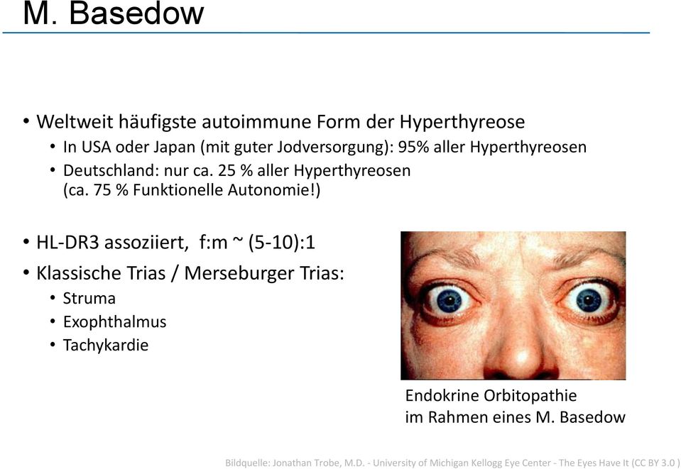 ) HL-DR3 assoziiert, f:m ~ (5-10):1 Klassische Trias / Merseburger Trias: Struma Exophthalmus Tachykardie Endokrine