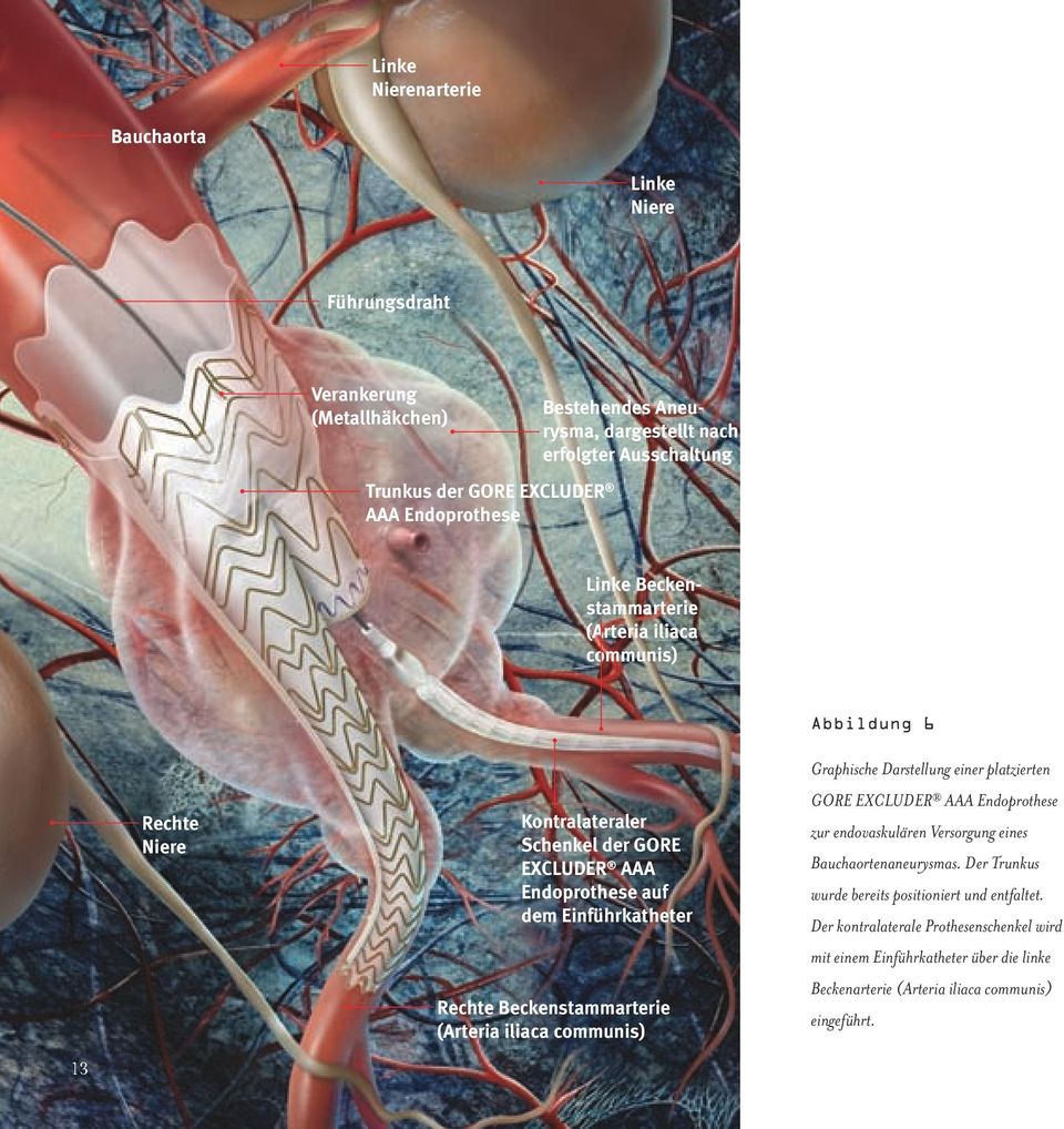 Beckenstammarterie (Arteria iliaca communis) Abbildung 6 Graphische Darstellung einer platzierten GORE EXCLUDER AAA Endoprothese zur endovaskulären Versorgung eines