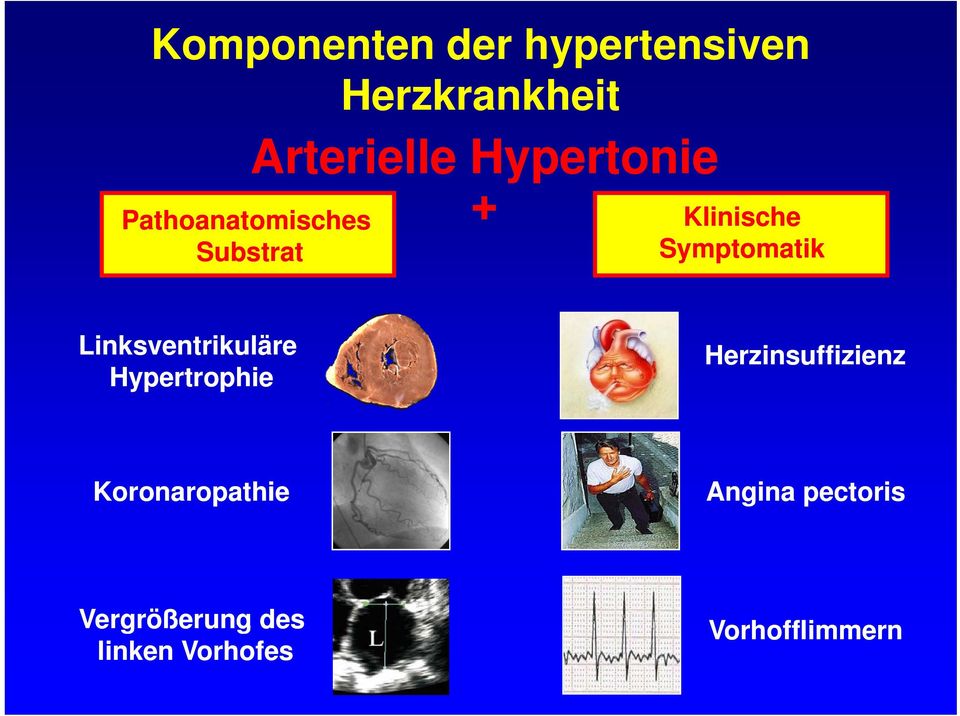 Symptomatik Linksventrikuläre Hypertrophie Herzinsuffizienz