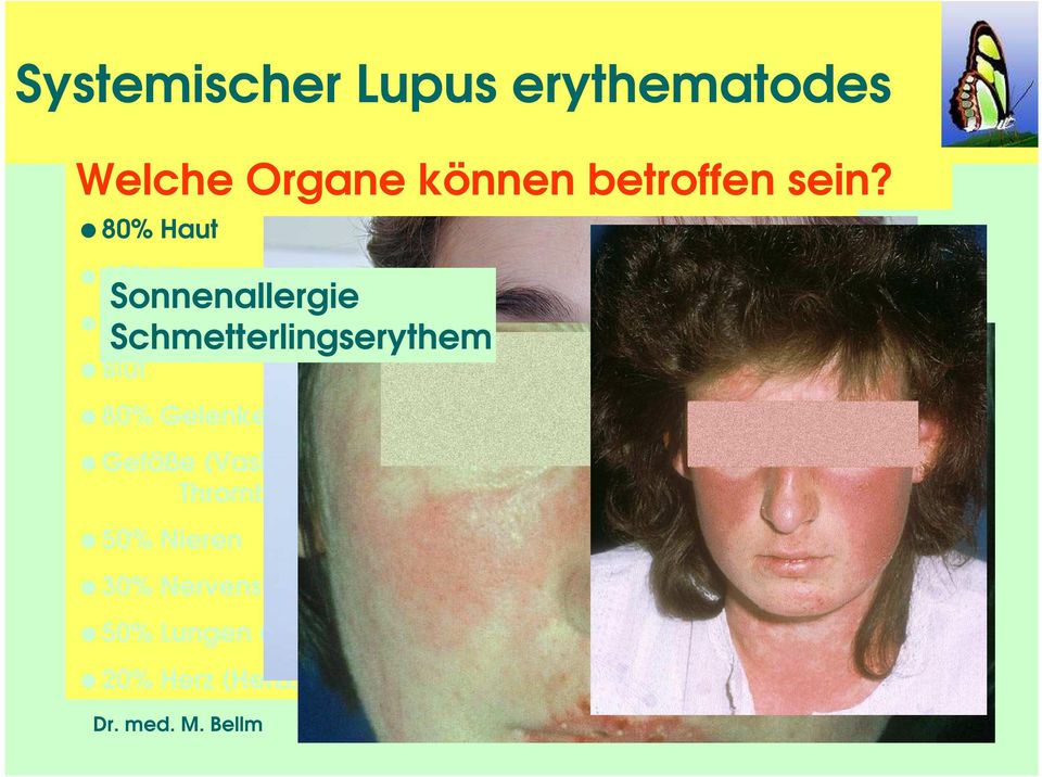 Blut 80% Gelenke und Muskeln Gefäße (Vaskulitis), Raynaud-Phänomen,