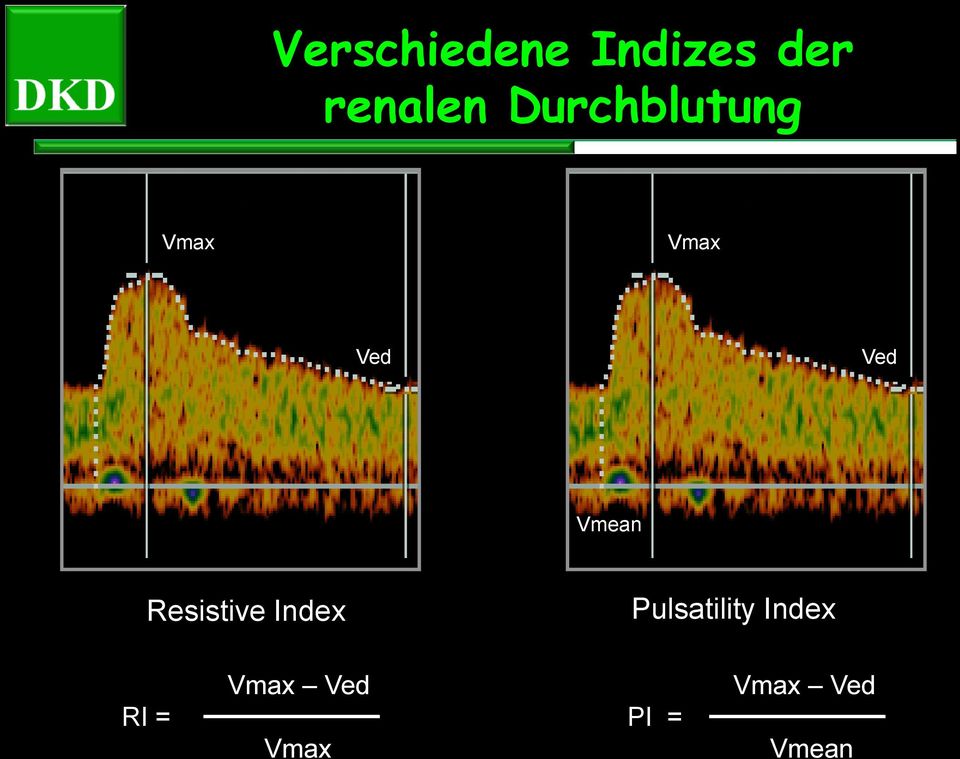 Vmean Resistive Index Pulsatility