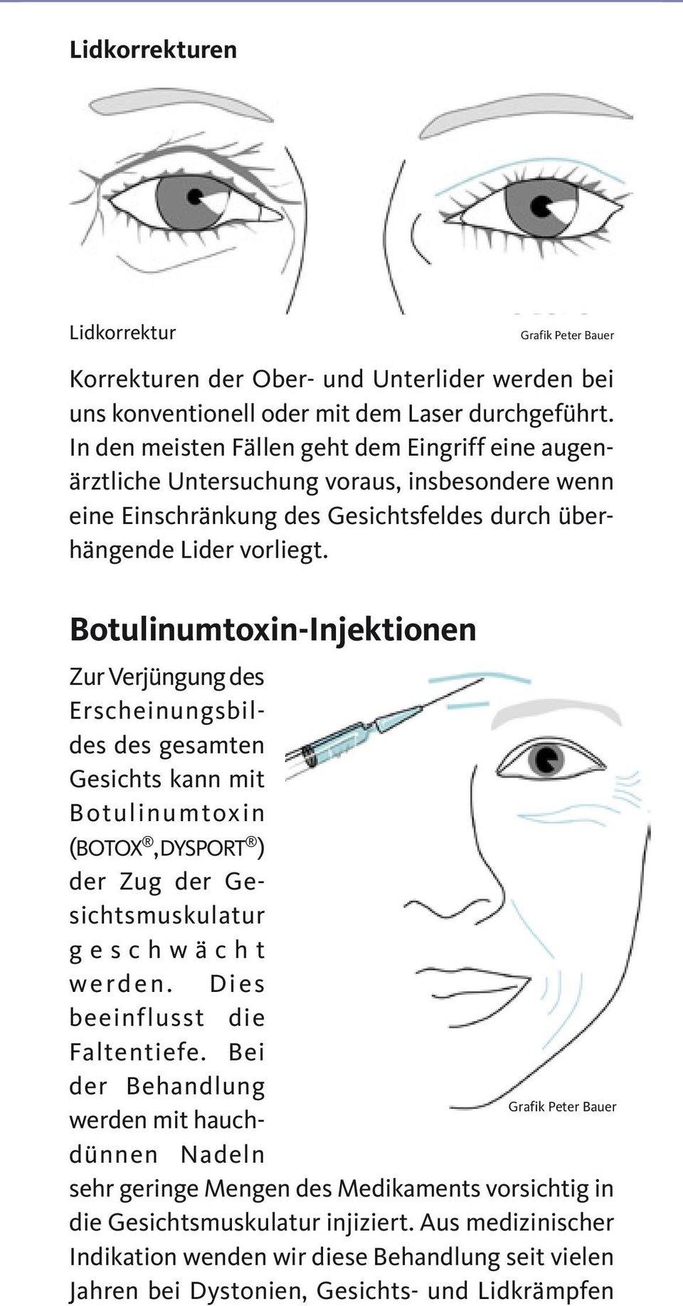 Botulinumtoxin-Injektionen Zur Verjüngung des Erscheinungsbildes des gesamten Gesichts kann mit Botulinumtoxin (BOTOX, DYSPORT ) der Zug der Gesichtsmuskulatur g e s c h w ä c h t werden.