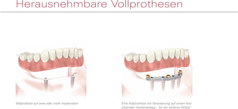 Vollprothese mit Verankerung auf einem