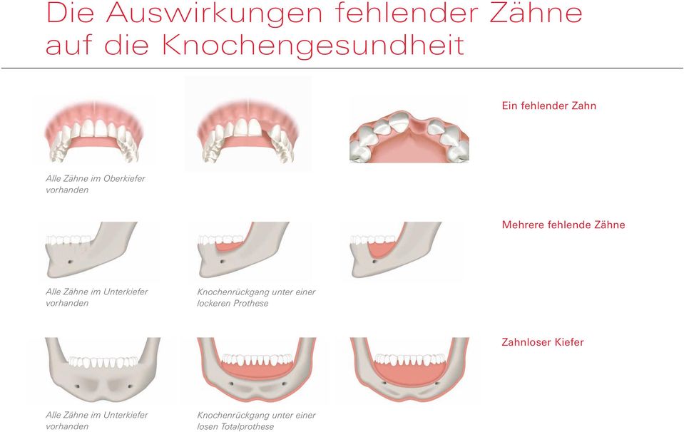 Unterkiefer vorhanden Knochenrückgang unter einer lockeren Prothese Zahnloser