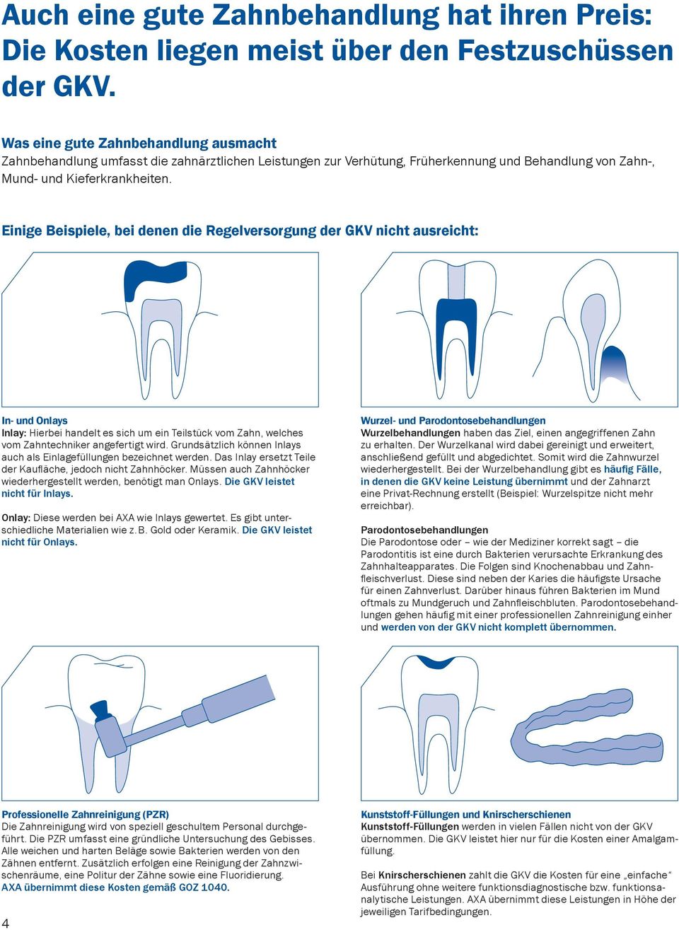 Einige Beispiele, bei denen die Regelversorgung der GKV nicht ausreicht: In- und Onlays Inlay: Hierbei handelt es sich um ein Teilstück vom Zahn, welches vom Zahntechniker angefertigt wird.
