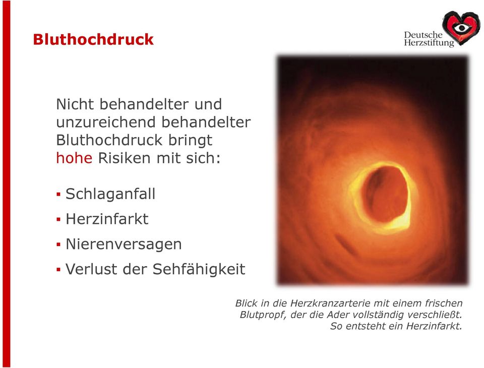 Nierenversagen Verlust der Sehfähigkeit Blick in die Herzkranzarterie mit