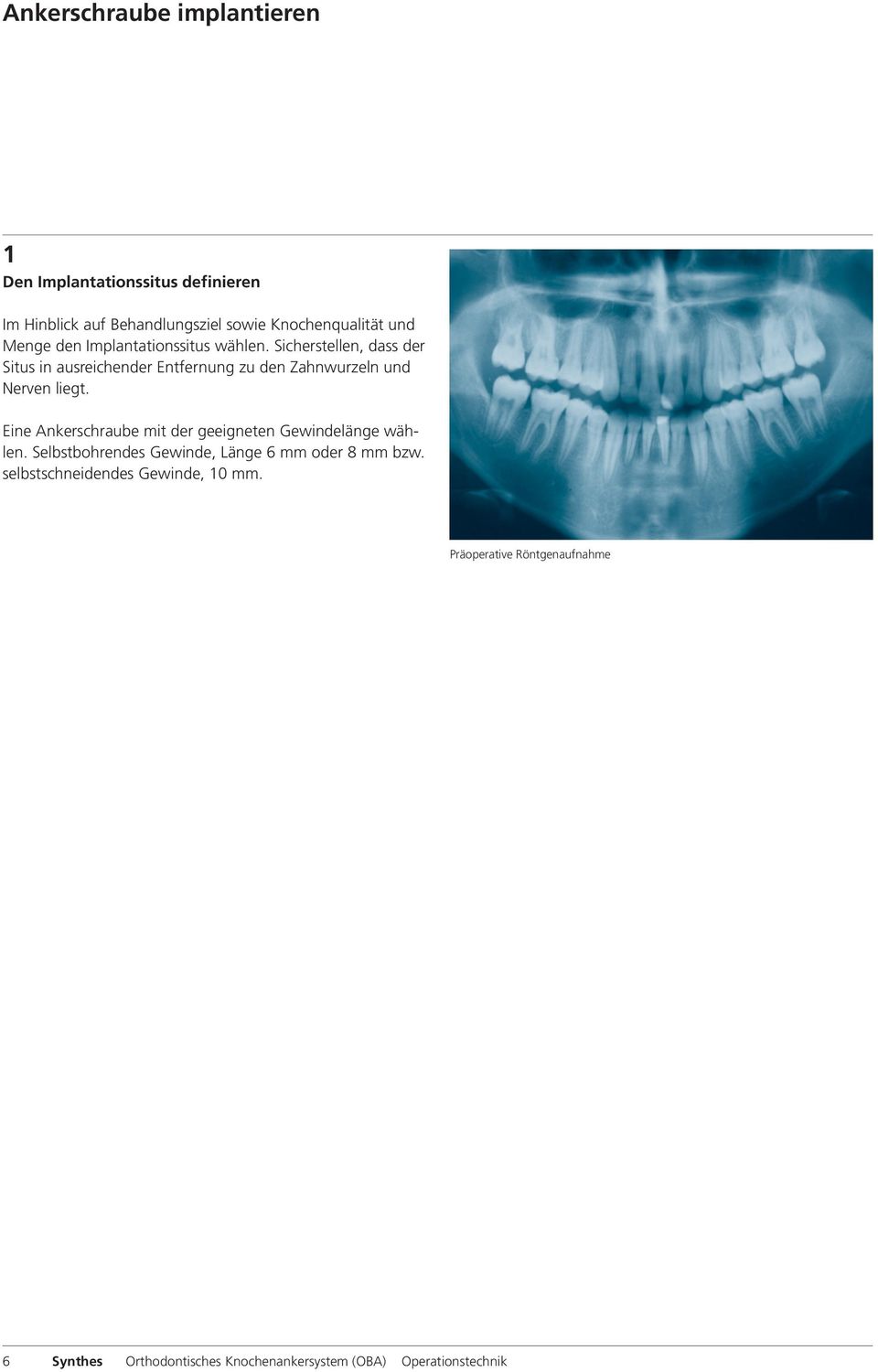 Sicherstellen, dass der Situs in ausreichender Entfernung zu den Zahnwurzeln und Nerven liegt.