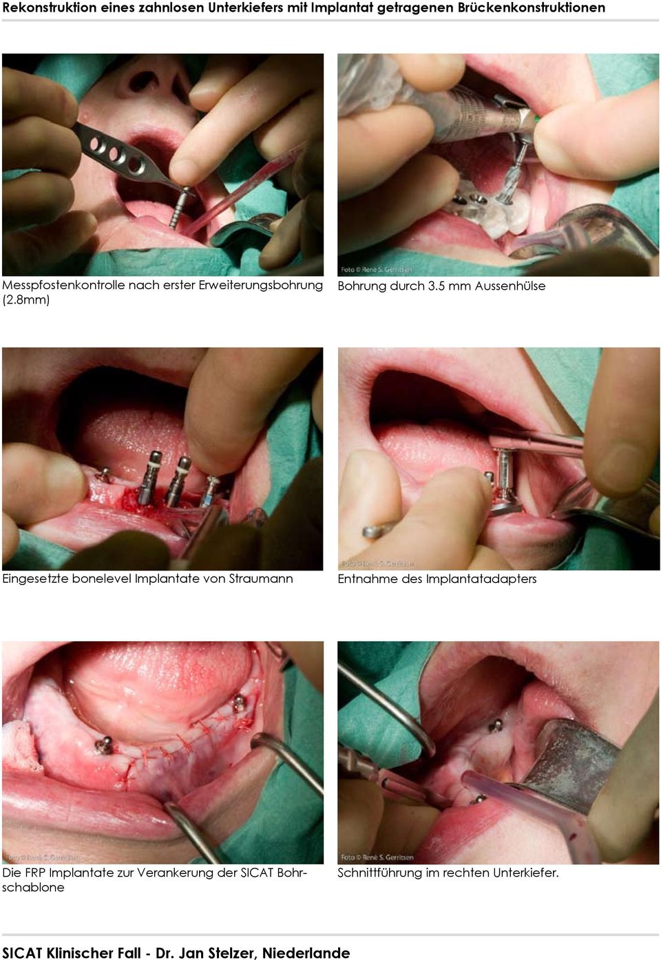 5 mm Aussenhülse Eingesetzte bonelevel Implantate von Straumann