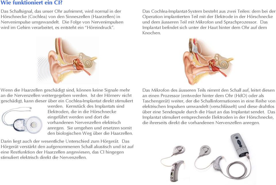 Das Cochlea-Implantat-System besteht aus zwei Teilen: dem bei der Operation implantierten Teil mit der Elektrode in der Hörschnecke und dem äusseren Teil mit Mikrofon und Sprachprozessor.