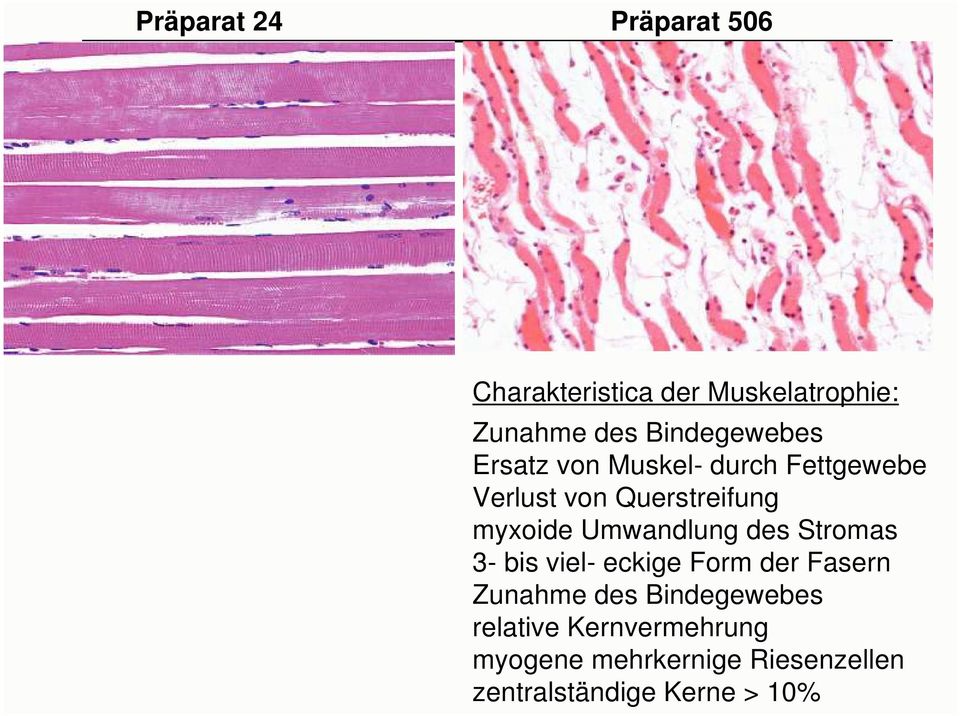 myxoide Umwandlung des Stromas 3- bis viel- eckige Form der Fasern Zunahme des