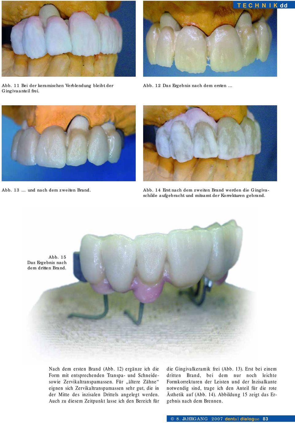 Für ältere Zähne eignen sich Zervikaltranspamassen sehr gut, die in der Mitte des inzisalen Drittels angelegt werden. Auch zu diesem Zeitpunkt lasse ich den Bereich für die Gingivalkeramik frei (Abb.