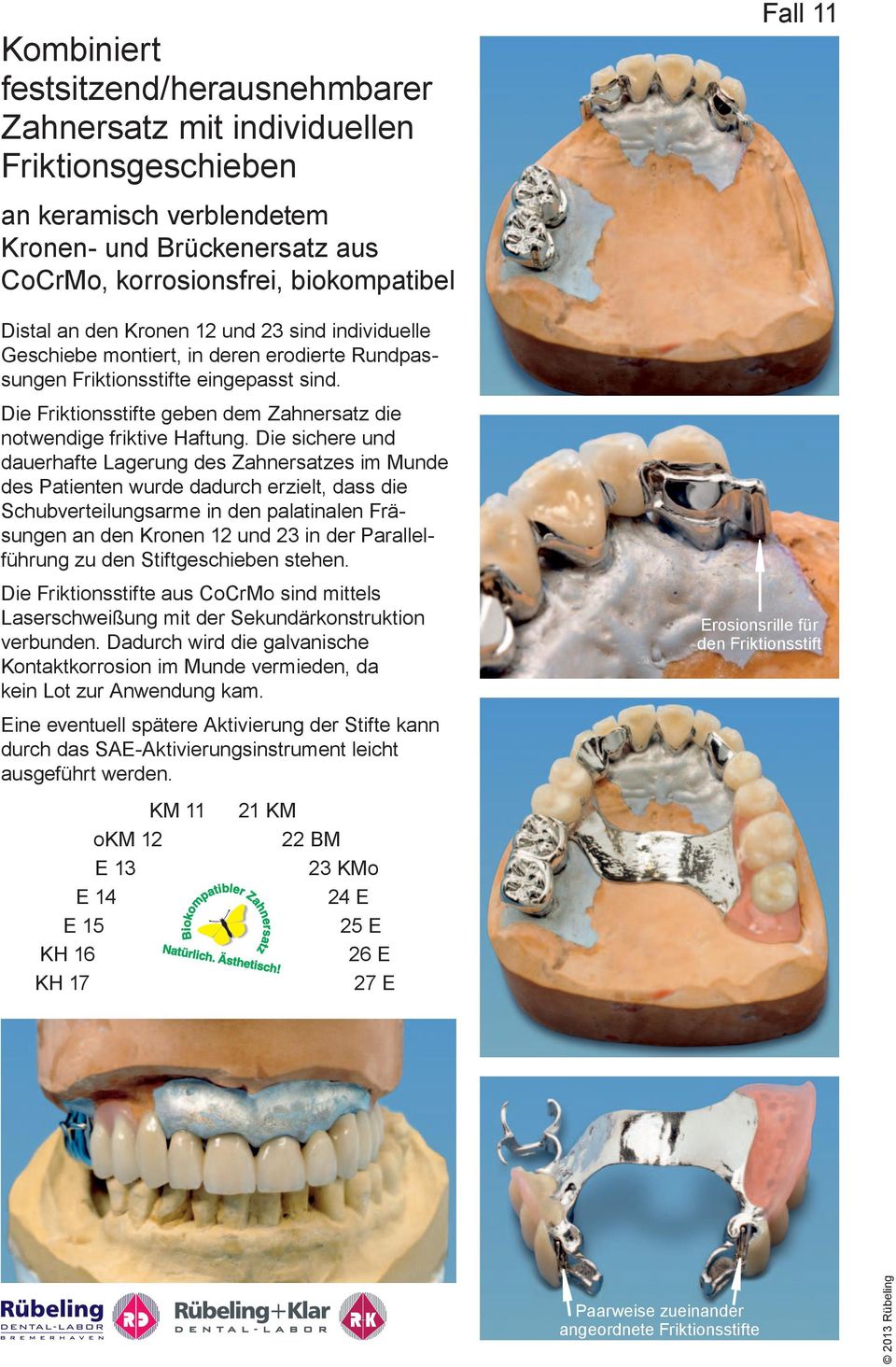 Die sichere und dauerhafte Lagerung des Zahnersatzes im Munde des Patienten wurde dadurch erzielt, dass die Schubverteilungsarme in den palatinalen Fräsungen an den Kronen 12 und 23 in der