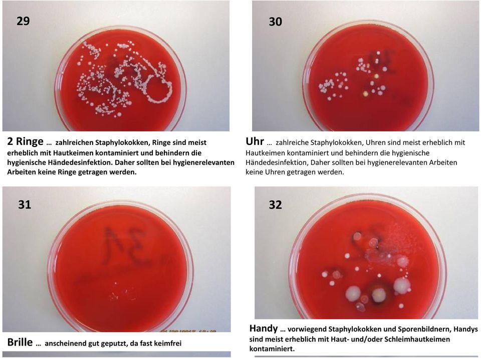 Uhr zahlreiche Staphylokokken, Uhren sind meist erheblich mit Hautkeimen kontaminiert und behindern die hygienische Händedesinfektion, Daher sollten bei