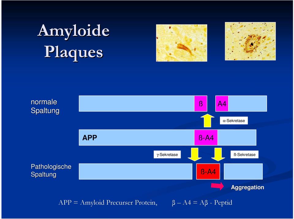 Pathologische Spaltung ß-A4 APP = Amyloid
