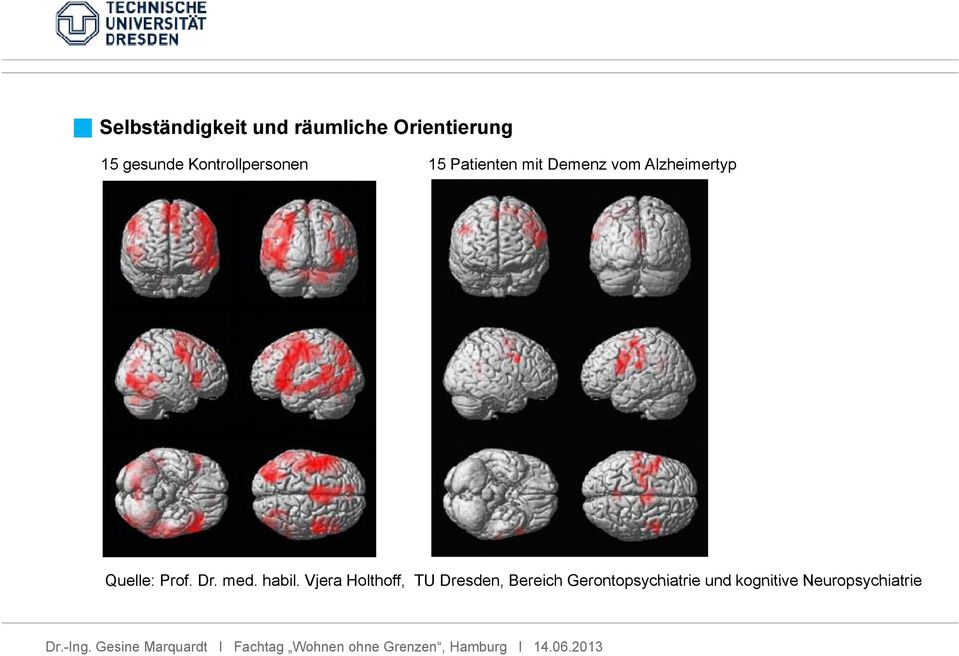 Alzheimertyp Quelle: Prof. Dr. med. habil.