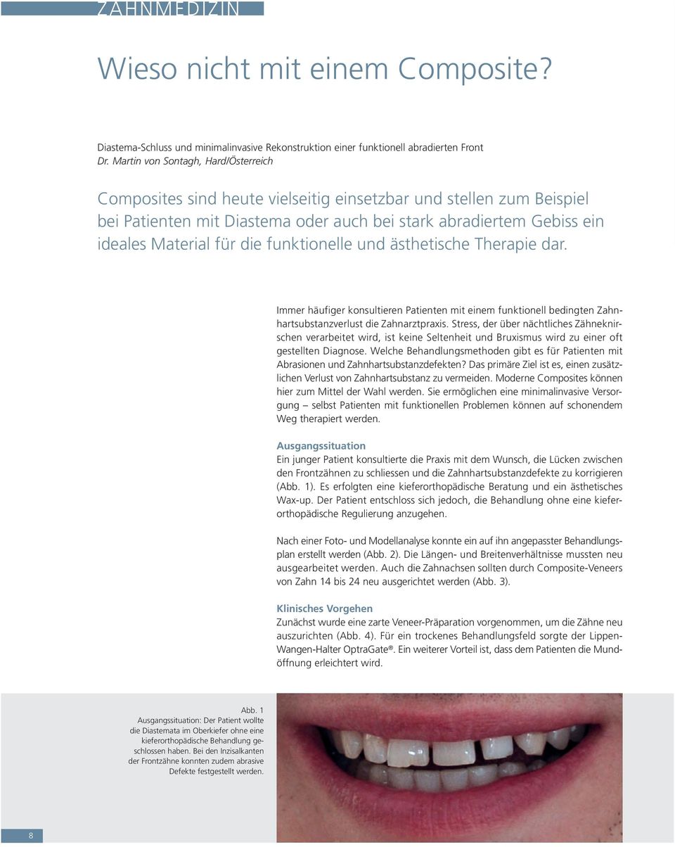funktionelle und ästhetische Therapie dar. Immer häufiger konsultieren Patienten mit einem funktionell bedingten Zahnhartsubstanzverlust die Zahnarztpraxis.