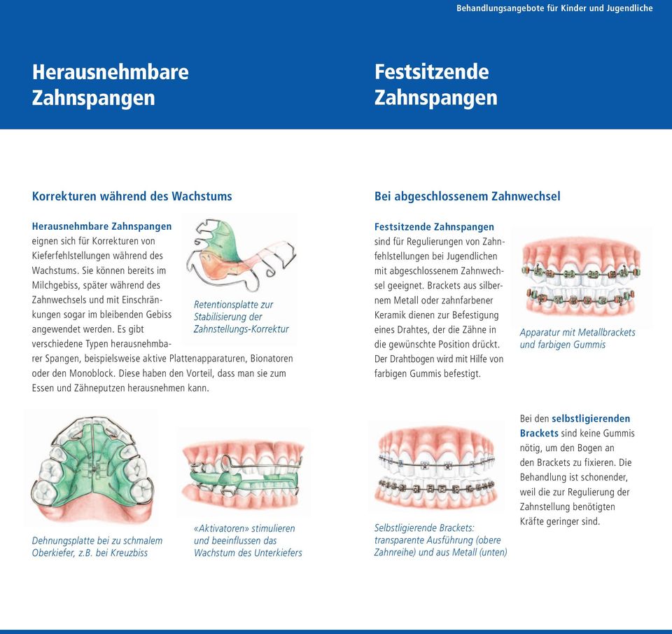Es gibt Zahnstellungs-Korrektur verschiedene Typen herausnehmbarer Spangen, beispielsweise aktive Platten apparaturen, Bionatoren oder den Monoblock.