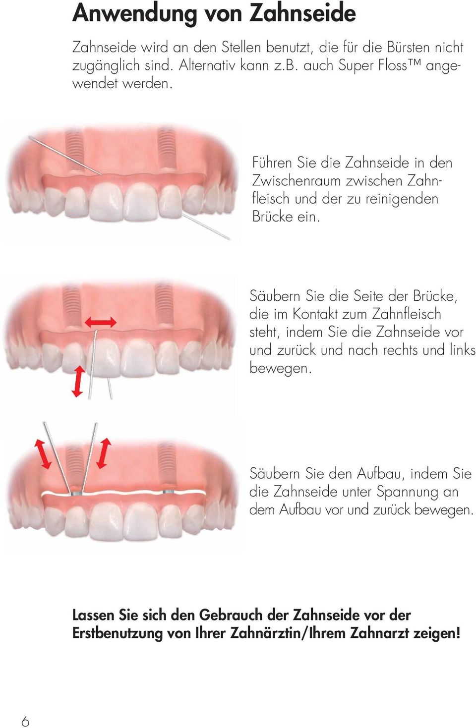 Säubern Sie die Seite der Brücke, die im Kontakt zum Zahnfleisch steht, indem Sie die Zahnseide vor und zurück und nach rechts und links bewegen.