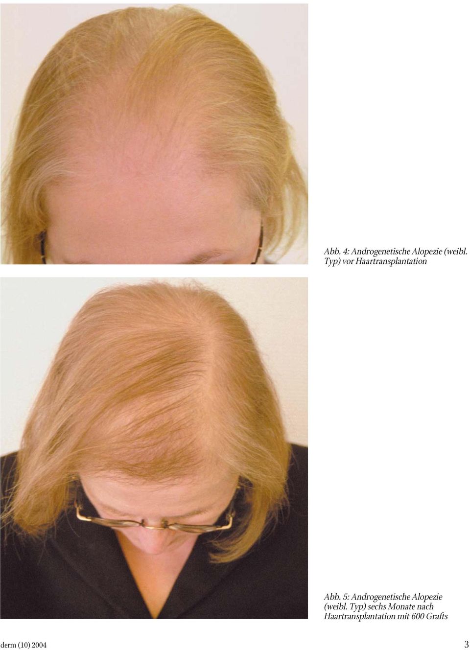 5: Androgenetische Alopezie (weibl.