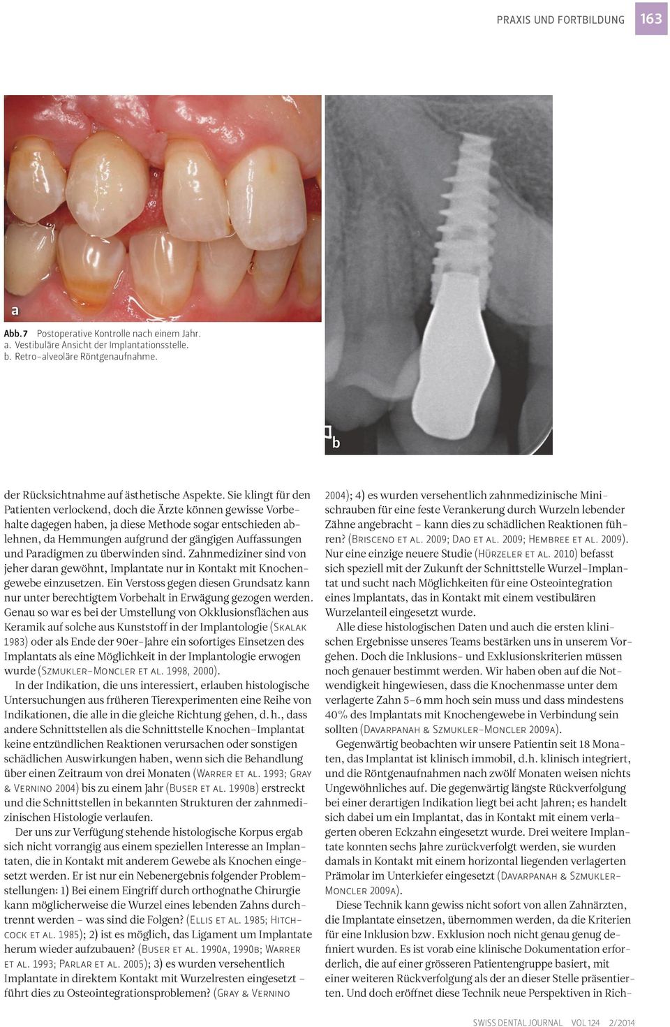 2010) efsst sich speziell mit der Zukunft der Schnittstelle Wurzel Implntt und sucht nch Möglichkeiten für eine Osteointegrtion eines Implntts, ds in Kontkt mit einem vestiulären Wurzel nteil