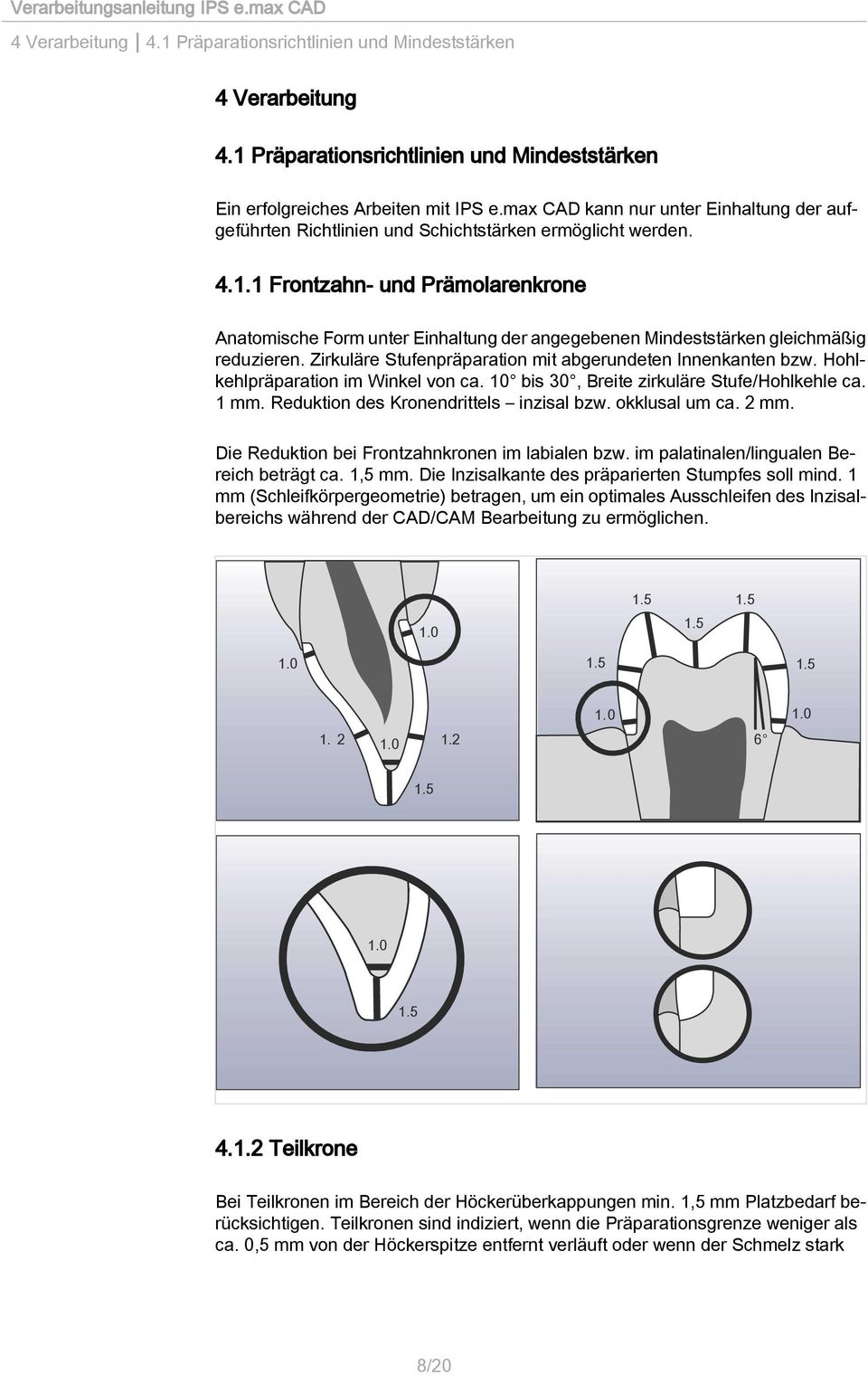 1 Frontzahn- und Prämolarenkrone Anatomische Form unter Einhaltung der angegebenen Mindeststärken gleichmäßig reduzieren. Zirkuläre Stufenpräparation mit abgerundeten Innenkanten bzw.