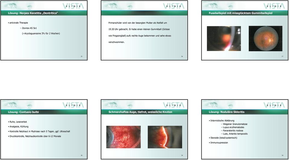 25 26 27 Lösung: Contusio bulbi Schmerzhaftes Auge, tiefrot, weissliche Knoten Lösung: Noduläre Skleritis Ruhe, Leseverbot Analgesie, Kühlung Kontrolle Netzhaut in Mydriase nach 5 Tagen, ggf.