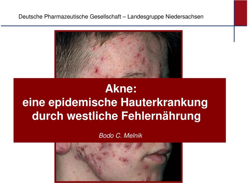 Niedersachsen Akne: eine epidemische