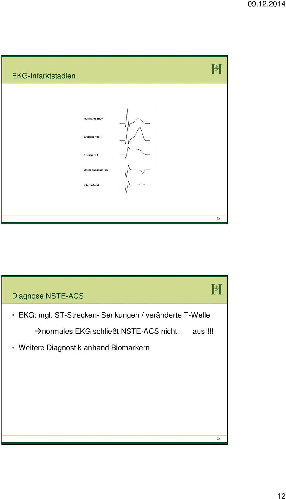 T-Welle normales EKG schließt NSTE-ACS nicht