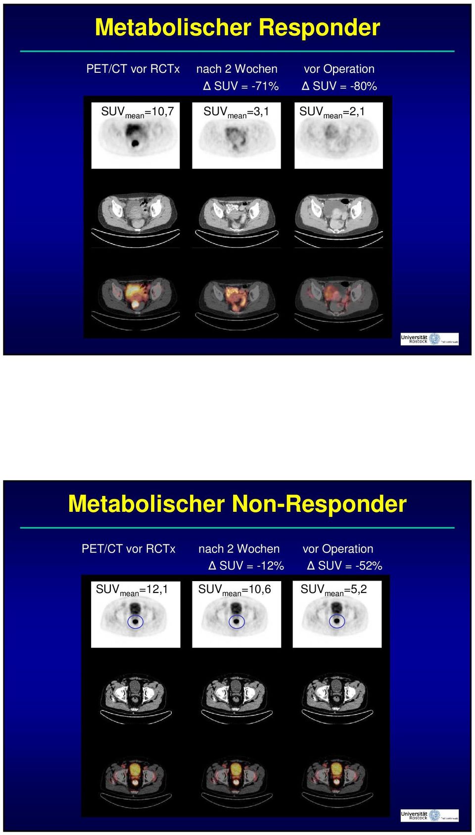 Metabolischer Non-Responder PET/CT vor RCTx nach 2 Wochen vor