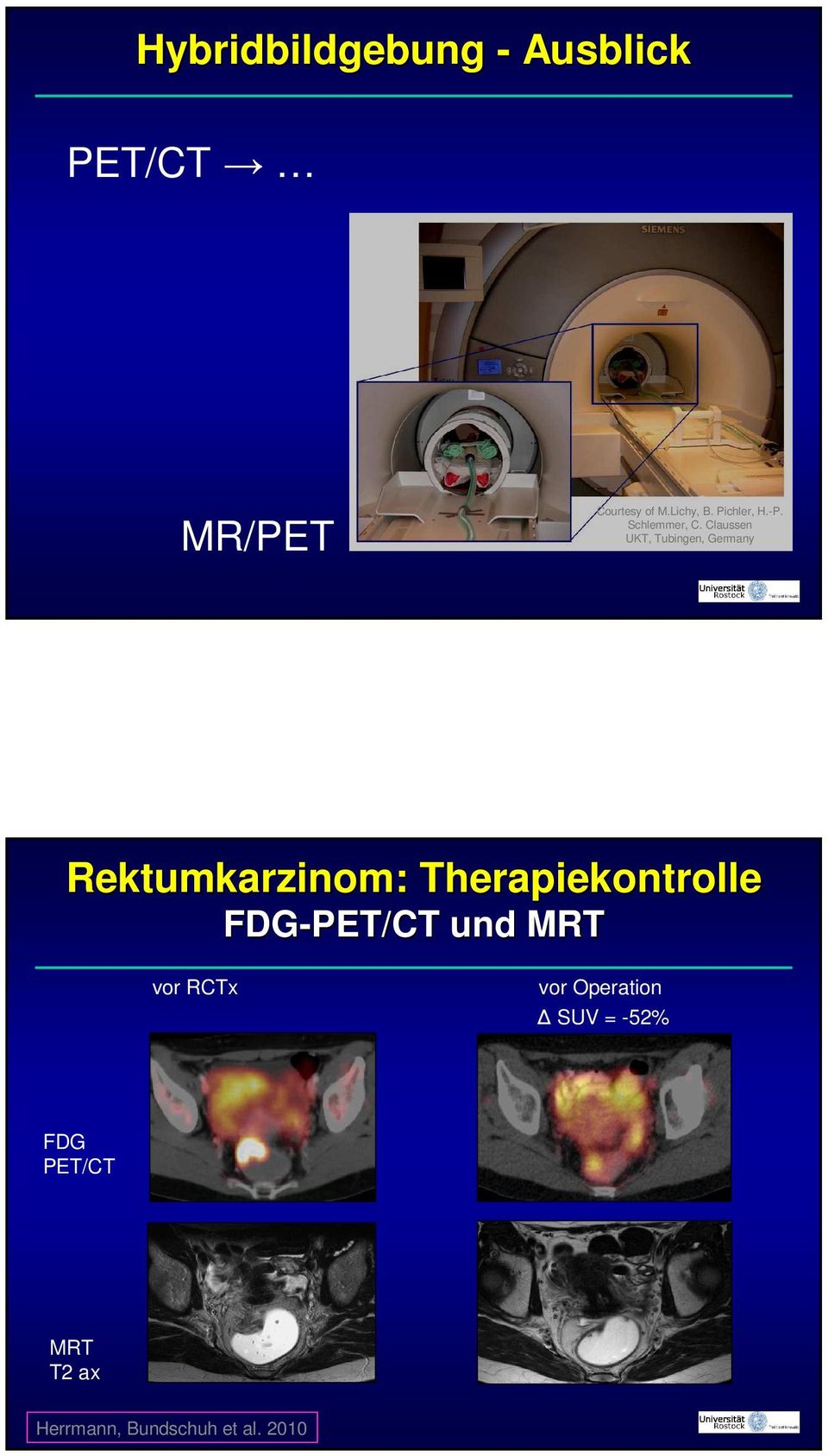Claussen UKT, Tubingen, Germany Rektumkarzinom: Therapiekontrolle