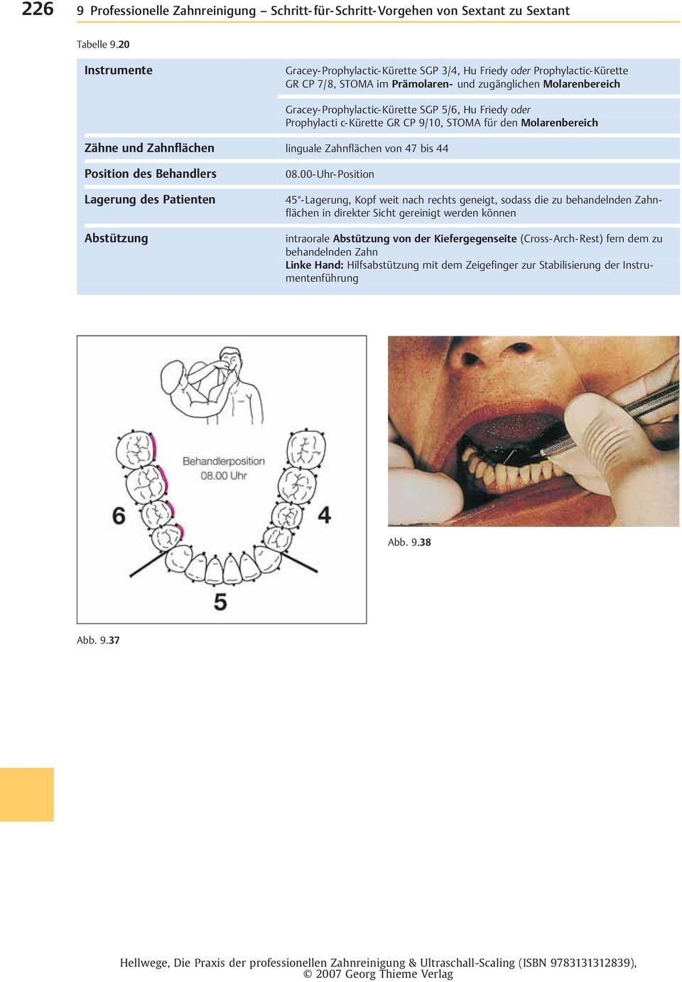 5/6, Hu Friedy oder Prophylacti c-kürette GR CP 9/10, STOMA für den Molarenbereich Zähne und Zahnflächen linguale Zahnflächen von 47bis 44 08.