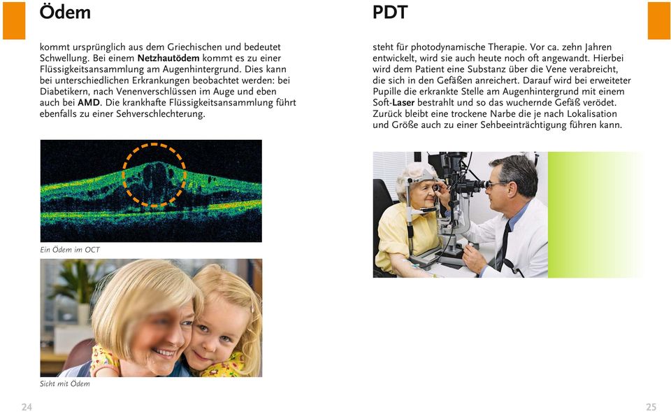 Die krankhafte Flüssigkeitsansammlung führt ebenfalls zu einer Sehverschlechterung. PDT steht für photodynamische Therapie. Vor ca. zehn Jahren entwickelt, wird sie auch heute noch oft angewandt.