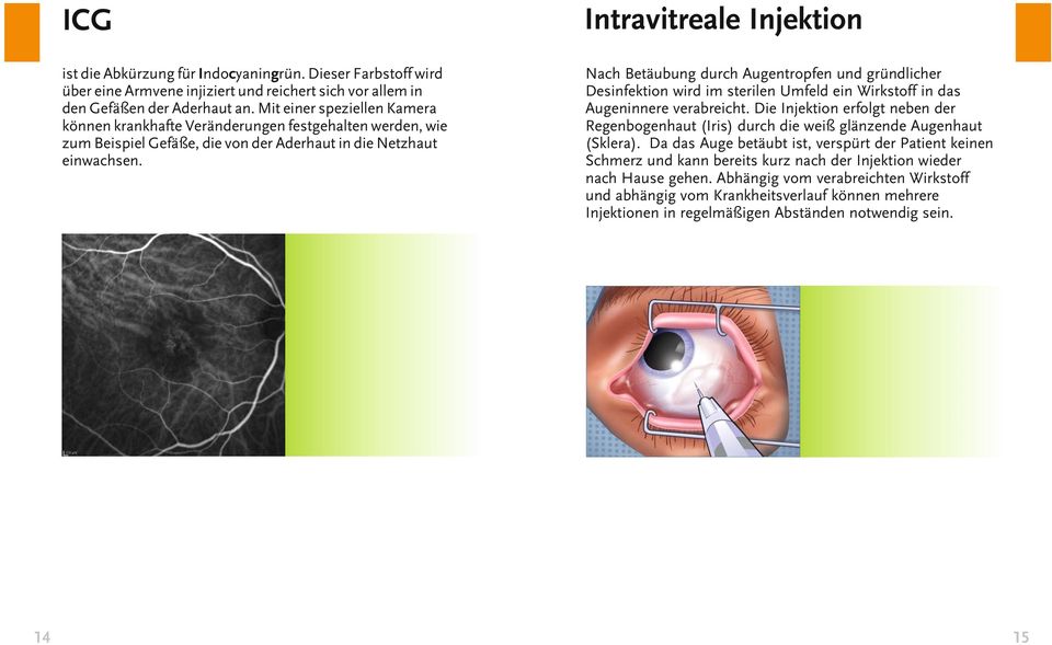 Intravitreale Injektion Nach Betäubung durch Augentropfen und gründlicher Desinfektion wird im sterilen Umfeld ein Wirkstoff in das Augeninnere verabreicht.