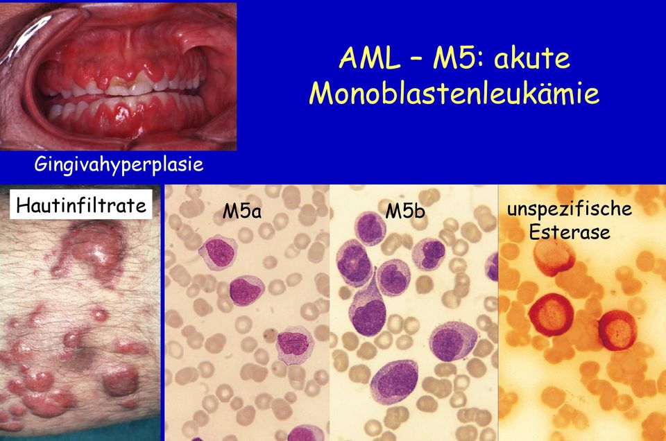 Gingivahyperplasie