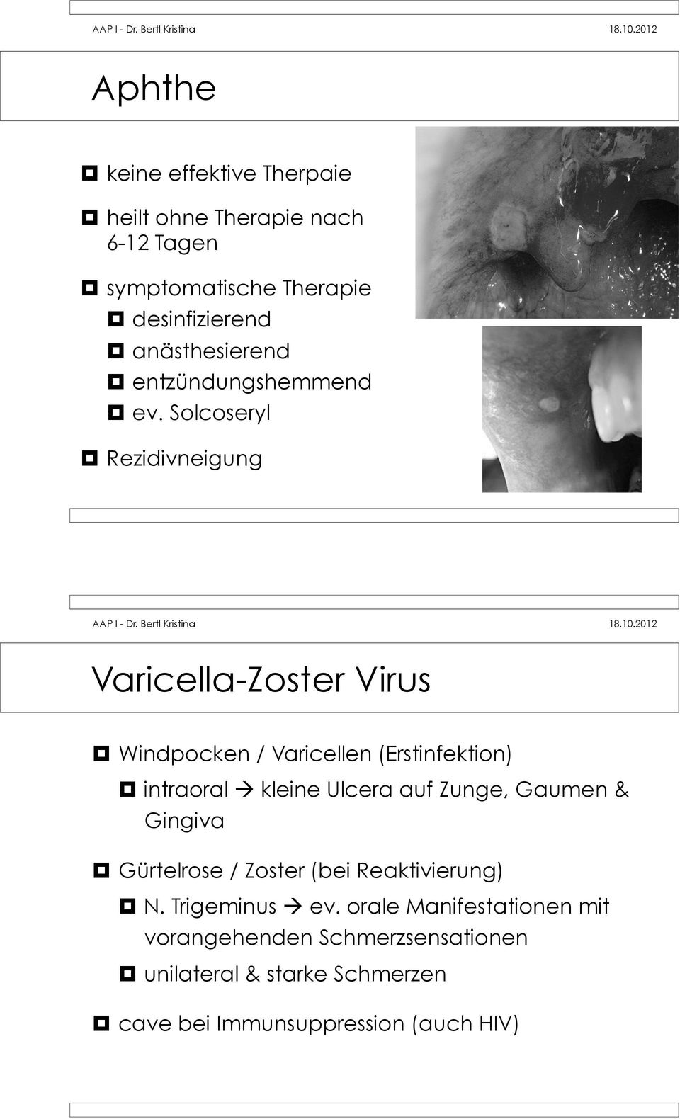 Windpocken / Varicellen (Erstinfektion)! intraoral! kleine Ulcera auf Zunge, Gaumen & Gingiva!