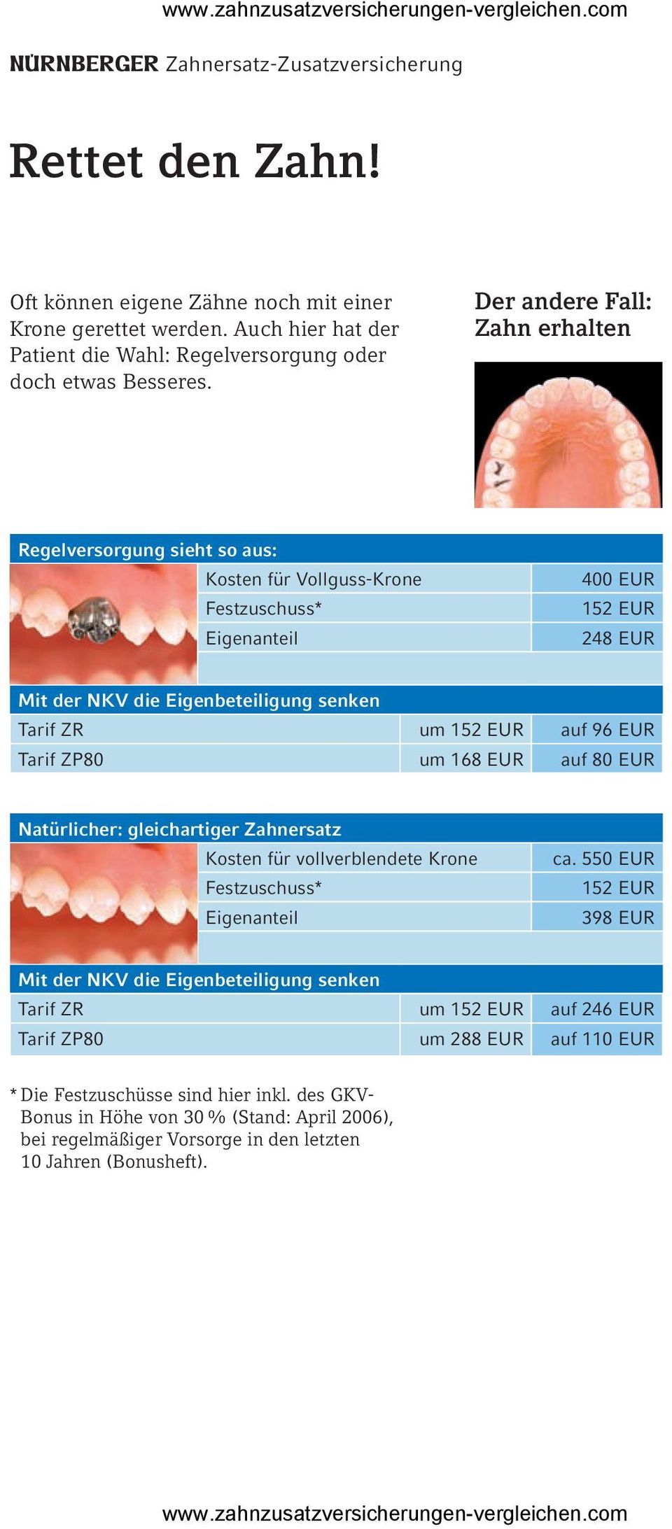 Der andere Fall: Zahn erhalten Regelversorgung sieht so aus: Kosten für Vollguss-Krone 400 EUR 152 EUR 248 EUR Tarif ZR um 152 EUR auf 96 EUR Tarif ZP80 um 168 EUR auf 80