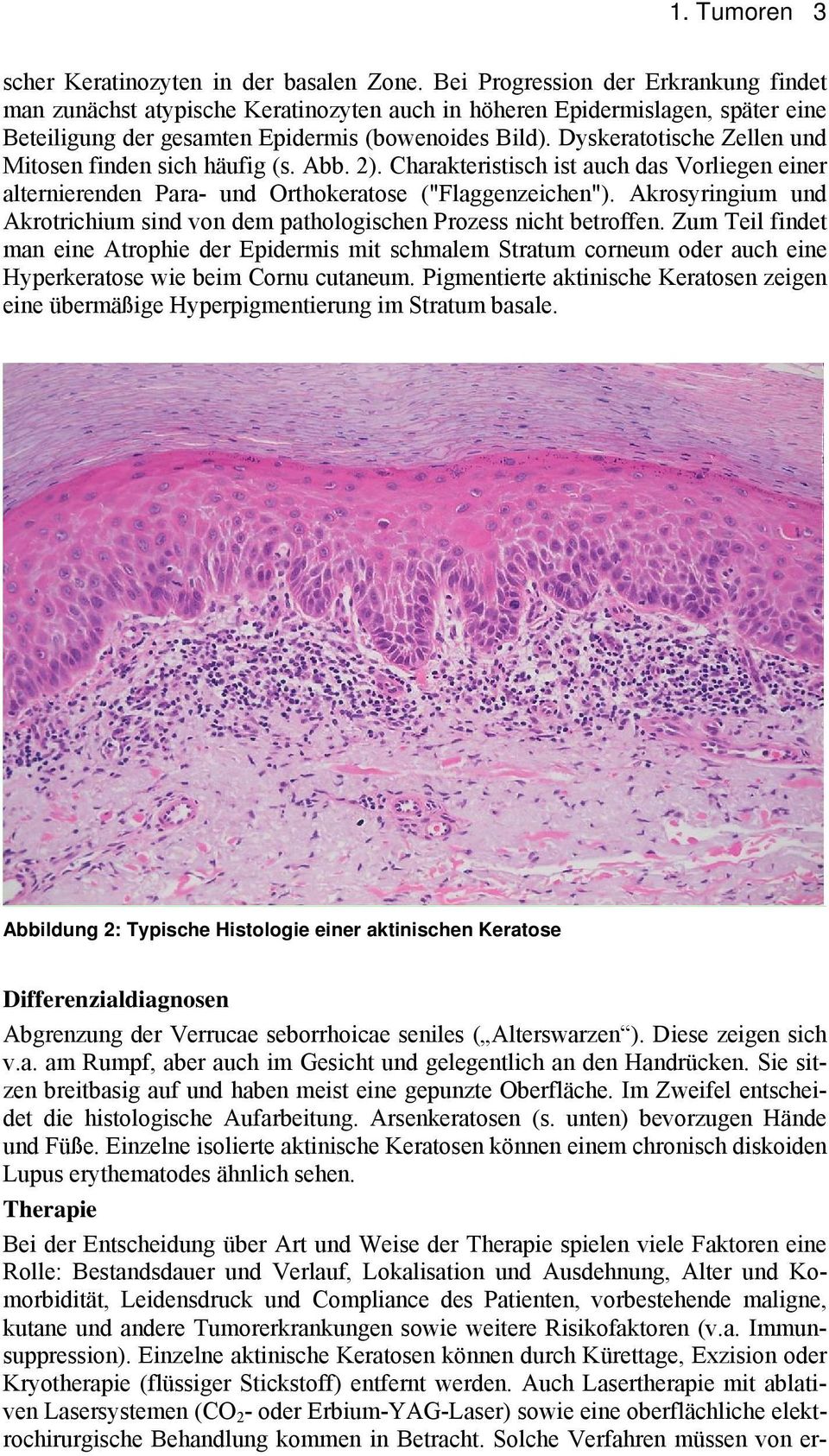 Dyskeratotische Zellen und Mitosen finden sich häufig (s. Abb. 2). Charakteristisch ist auch das Vorliegen einer alternierenden Para- und Orthokeratose ("Flaggenzeichen").
