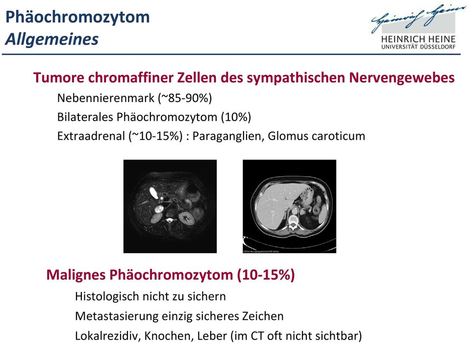 Paraganglien, Glomus caroticum Malignes Phäochromozytom (10 15%) Histologisch nicht zu