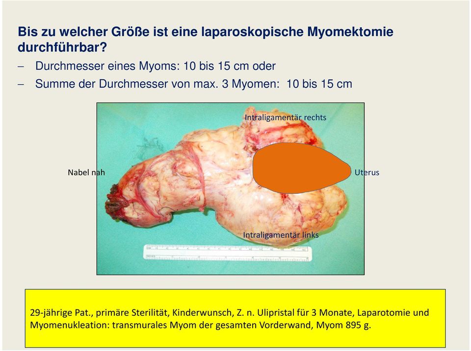 3 Myomen: 10 bis 15 cm Intraligamentär rechts Nabel nah Uterus Intraligamentär links 29-jährige Pat.