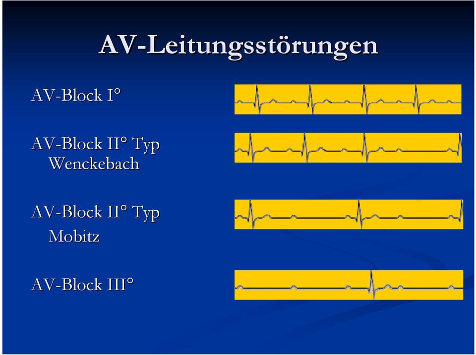 Typ Wenckebach AV-Block