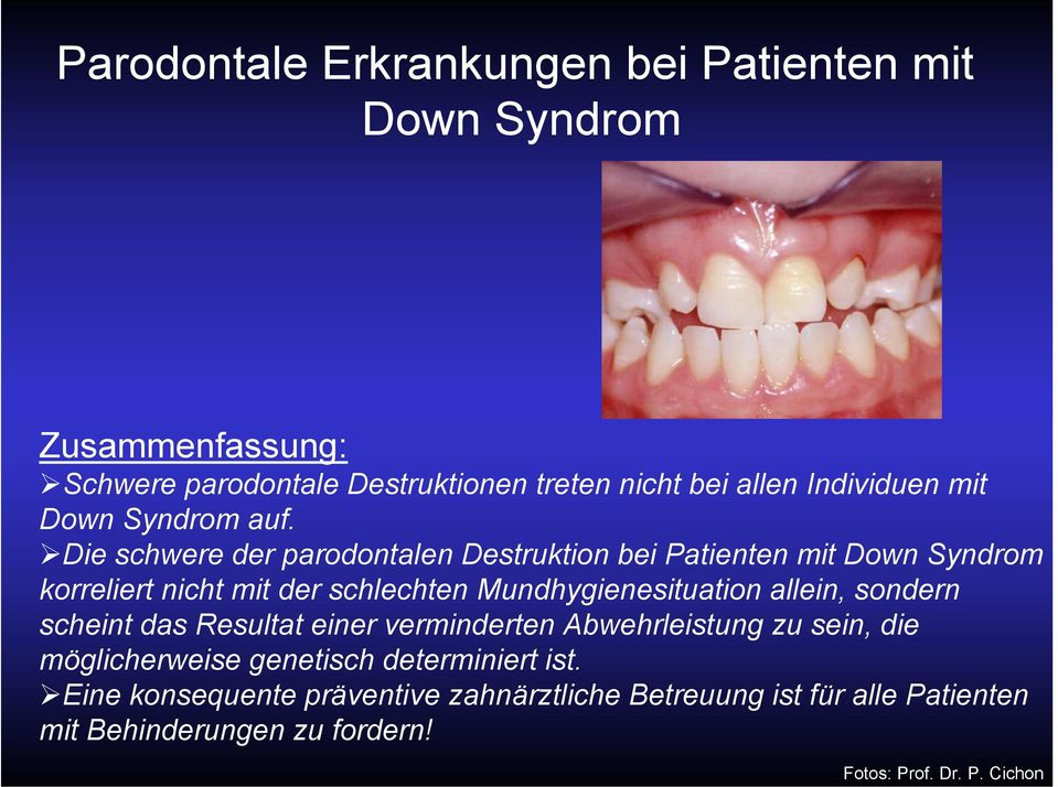 Die schwere der parodontalen Destruktion bei Patienten mit Down Syndrom korreliert nicht mit der schlechten Mundhygienesituation allein,