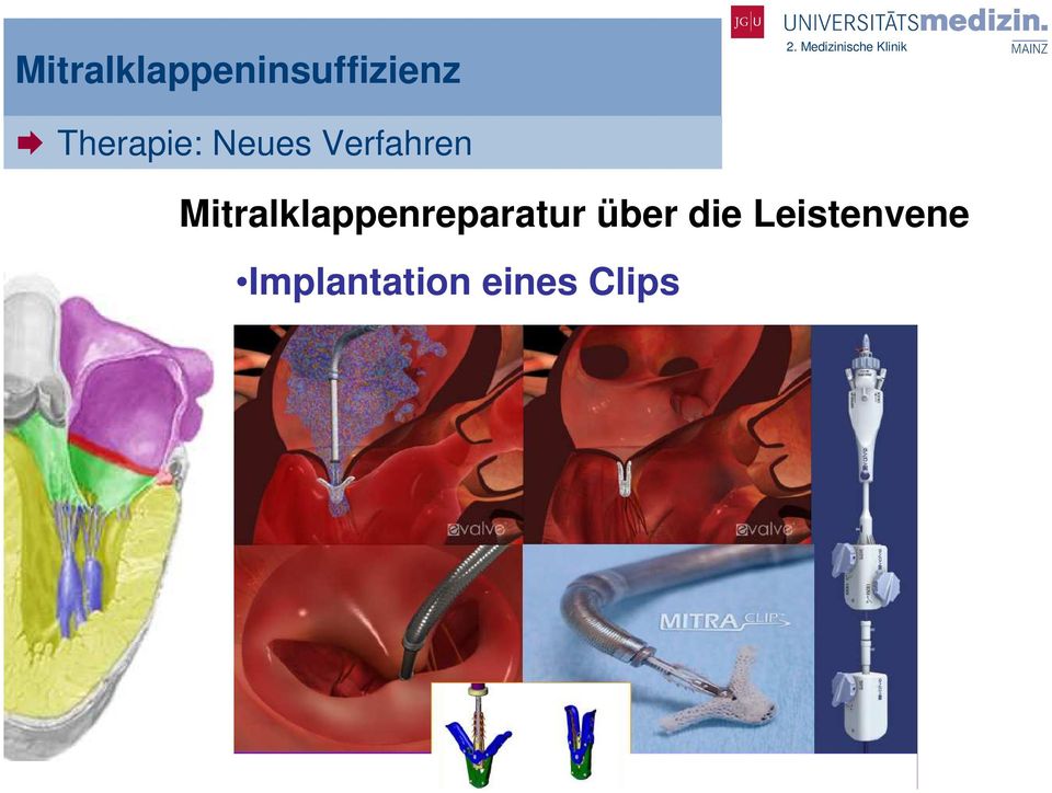 Verfahren Mitralklappenreparatur