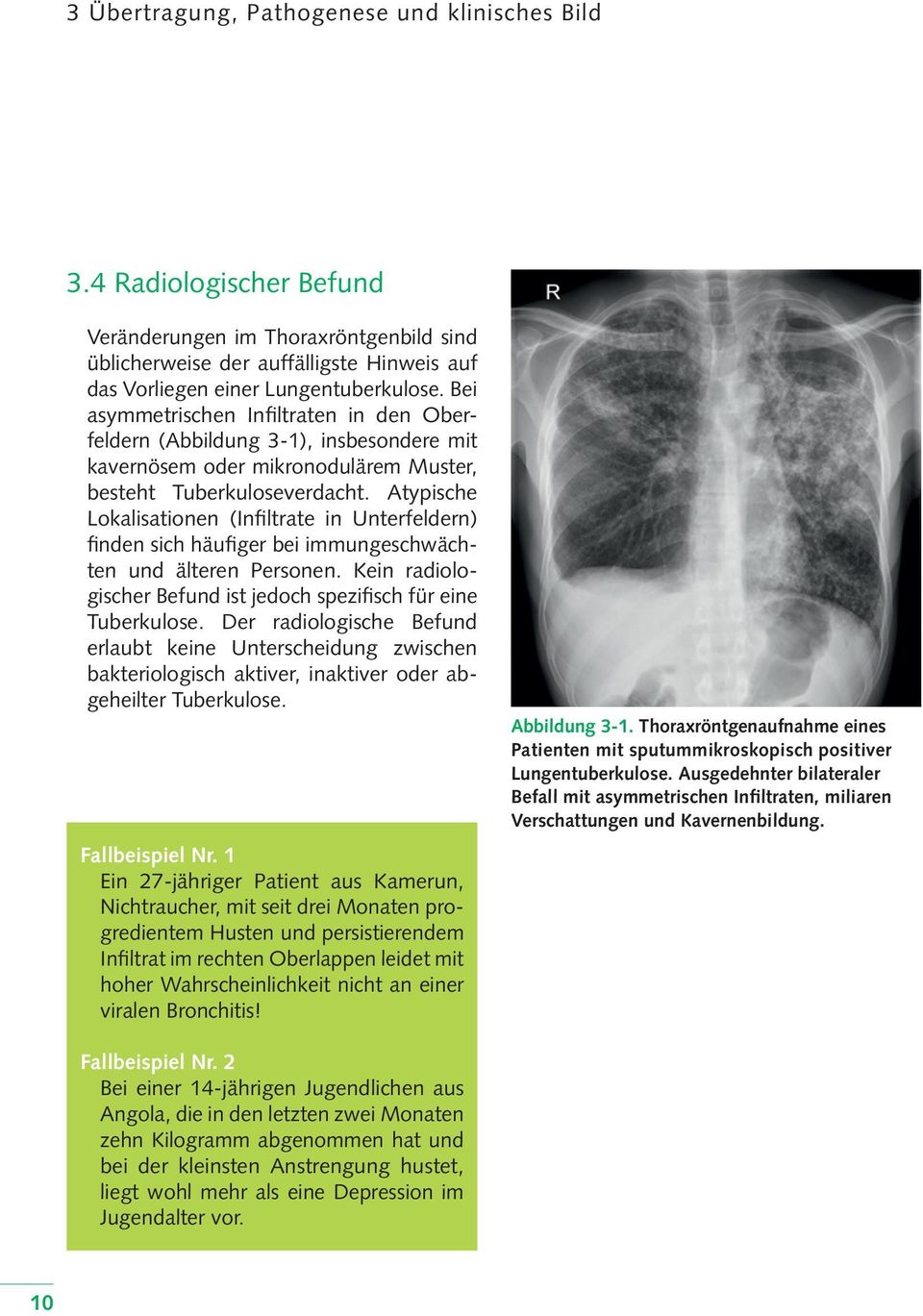 Atypische Lokalisationen (Infiltrate in Unterfeldern) finden sich häufiger bei immungeschwächten und älteren Personen. Kein radiologischer Befund ist jedoch spezifisch für eine Tuberkulose.