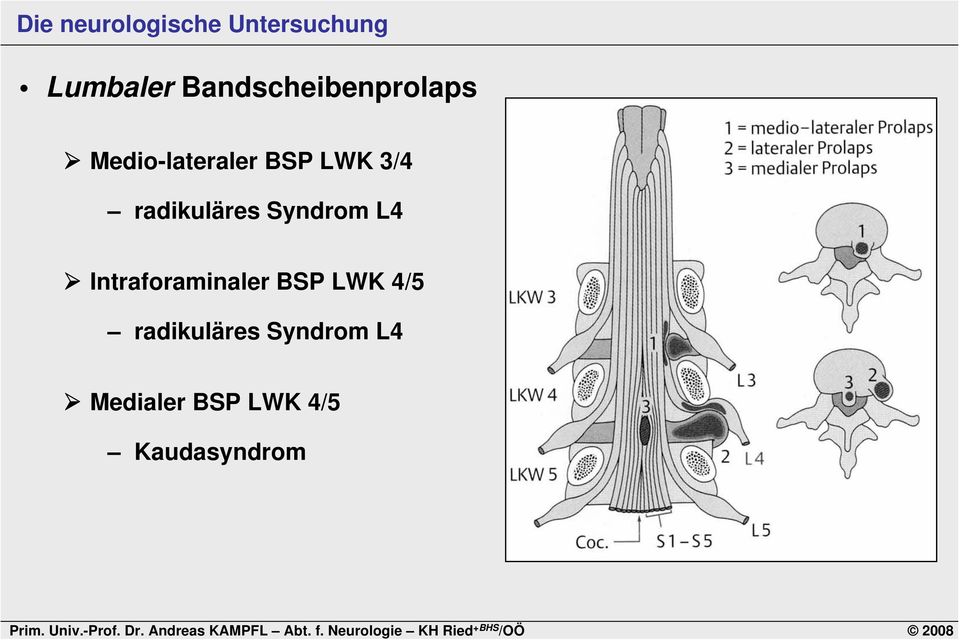 Syndrom L4 Intraforaminaler BSP LWK 4/5